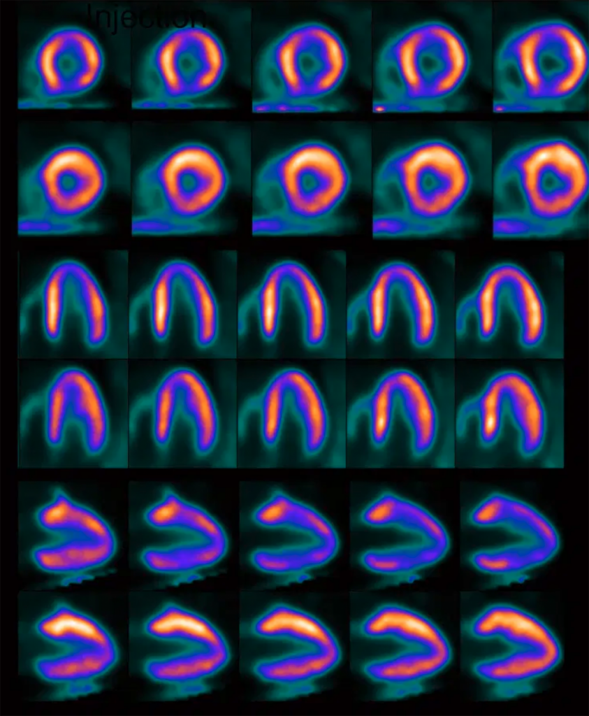 13N氨水可准确检测冠状动脉疾病，具有高质量图像、低辐射暴露、高诊断性等特点 | IBA - Radio Pharma Solutions